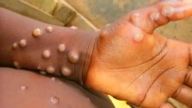 السودان تعلن تسجيل أول حالة مؤكدة بجدري القرود