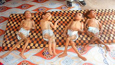 4 أطفال مصابون بسوء التغذية الوخيم