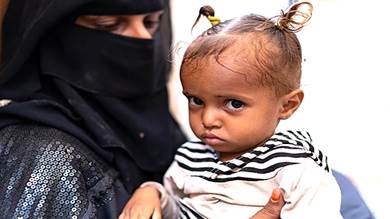 الصحة العالمية: 80% من الأطفال يعانون من الحصبة في اليمن