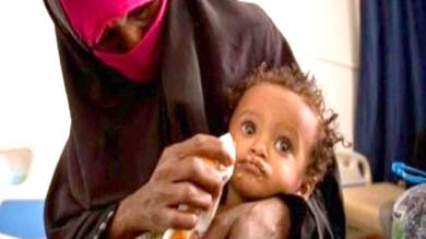 سوء التغذية يرفع معدلات تقزم الأطفال في اليمن